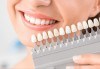 Неустоима усмивка! Професионално избелване на зъби до 3 тона в АГППДП Калиатеа Дент - thumb 4