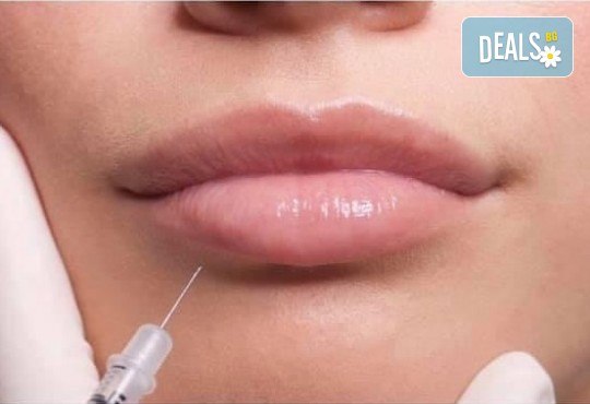 Уголемяване на устни с 1мл хиалуронов филър извършено от лекар-специалист в Медицински център за медико-естетични процедури! - Снимка 3