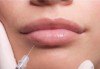 Уголемяване на устни с 1мл хиалуронов филър извършено от лекар-специалист в Медицински център за медико-естетични процедури! - thumb 3