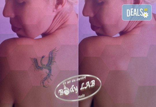 Премахване на всички видове татуировки и цветове в BodyLab Studio - Снимка 1