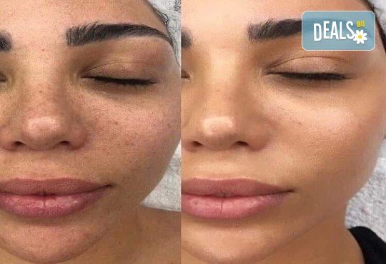 High Frequency Facial - нежно почистване на лицето с колагенов серум, стимулира естетсвеното производство на колаген от кожата.в Makeup & Beauty Private Studio - Снимка 2