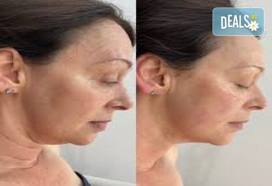 7D HIFU - гладка, млада, стегната и сияйна кожа, чрез нехирургично лечение, с изключителен клиничен ефект в Studio Mystic Derm - Снимка 2