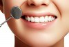 Фотополимерна пломба, преглед, план на лечение и почистване на зъбен камък в Дентален кабинет д-р Маринашева - thumb 1