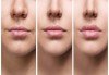 Красиви устни! Уголемяване на устни и запълване на бръчки с хиалуронов гел в Център Хелти Лайф, Пловдив - thumb 3