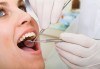 Почистване на зъбен камък с ултразвуков скалер в дентален кабинет д-р Чорбаджаков - жк Дружба - thumb 1