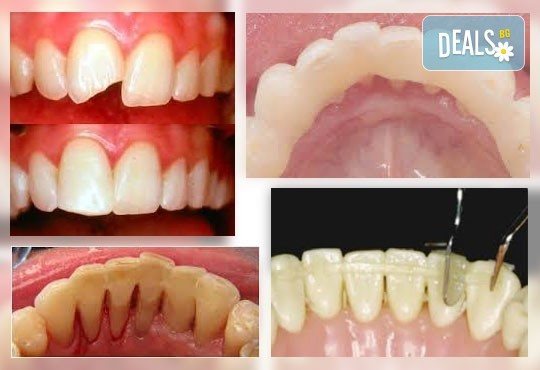 За здрави зъби! Фотополимерна пломба или почистване на зъбен камък с ултразвук, полиране и обстоен преглед в Дентална клиника Персенк! - Снимка 2