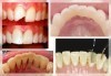 За здрави зъби! Фотополимерна пломба или почистване на зъбен камък с ултразвук, полиране и обстоен преглед в Дентална клиника Персенк! - thumb 2