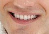 Грижа за красива усмивка! Обстоен стоматологичен преглед и почистване на зъбен камък, бонус от дентален кабинет д-р Шабанска! - thumb 1