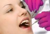 Лечение на зъбен кариес и поставяне на фотополимерна пломба с висококачествен фотополимер, преглед и план за лечение от д-р Чорбаджаков, ж.к. Дружба - thumb 1