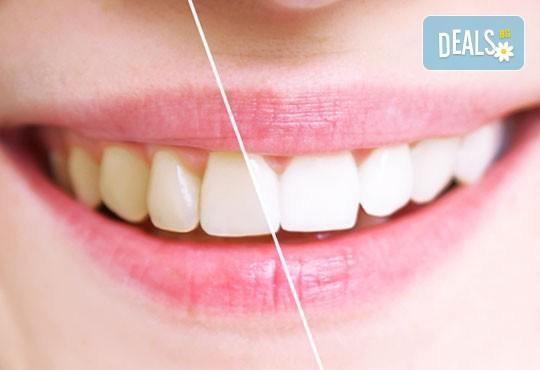 Професионално избелване на зъби с фотополимерна лампа, почистване на зъбен камък, полиране на зъбите, преглед и план на лечение от д-р Чорбаджаков, ж.к. Дружба - Снимка 1