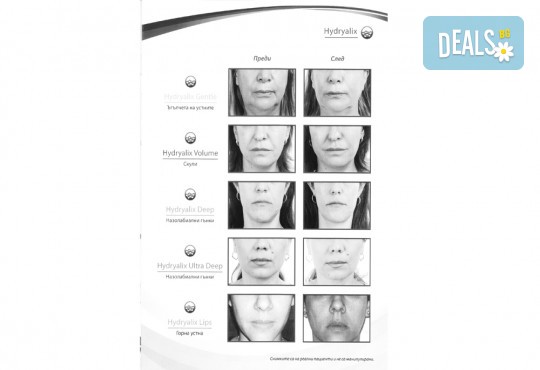 Обем и контур за устни с качествен филър по избор Overage или Hydryalix от SunClinic и д-р Светла Петкова - Снимка 4