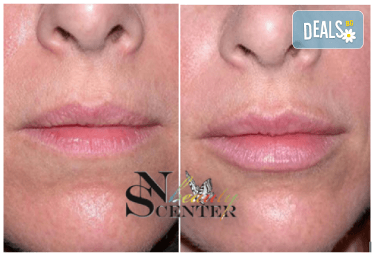 Безиглено уголемяване на устни или попълване на бръчки с американски хиалуронов филър и ултразвук от NSB Beauty Center! - Снимка 3