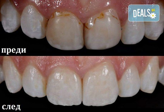 Високоестетична фотополимерна фасета (бондинг) на един зъб от дентален кабинет д-р Чорбаджаков - ж.к. Дружба 1 - Снимка 4