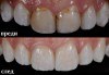 Високоестетична фотополимерна фасета (бондинг) на един зъб от дентален кабинет д-р Чорбаджаков - ж.к. Дружба 1 - thumb 4