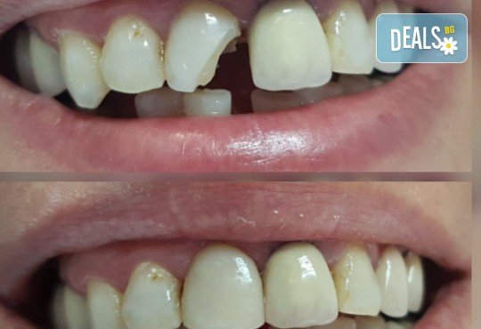 Високоестетична фотополимерна фасета (бондинг) на един зъб от дентален кабинет д-р Чорбаджаков - ж.к. Дружба 1 - Снимка 5