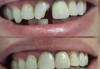 Високоестетична фотополимерна фасета (бондинг) на един зъб от дентален кабинет д-р Чорбаджаков - ж.к. Дружба 1 - thumb 5