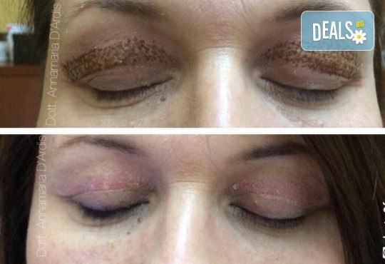 Незабавен резултат с видимо по-свеж поглед! Неоперативно повдигане на горен клепач и намаляване на торбичките под очите (блефароплсатика) от SunClinic! - Снимка 4