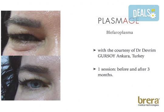 Незабавен резултат с видимо по-свеж поглед! Неоперативно повдигане на горен клепач и намаляване на торбичките под очите (блефароплсатика) от SunClinic! - Снимка 6