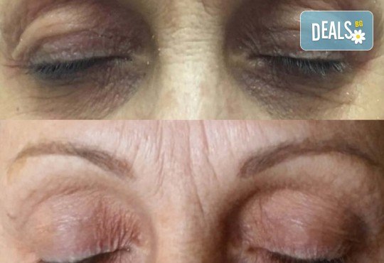 Незабавен резултат с видимо по-свеж поглед! Неоперативно повдигане на горен клепач и намаляване на торбичките под очите (блефароплсатика) от SunClinic! - Снимка 5