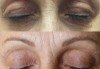 Незабавен резултат с видимо по-свеж поглед! Неоперативно повдигане на горен клепач и намаляване на торбичките под очите (блефароплсатика) от SunClinic! - thumb 5