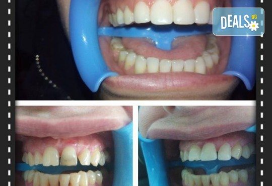 Красива усмивка с бондинг - поставяне на фотополимерна фаcета на един зъб в дентална клиника Персенк! - Снимка 4