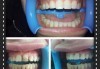 Красива усмивка с бондинг - поставяне на фотополимерна фаcета на един зъб в дентална клиника Персенк! - thumb 4