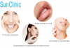 Обем и контур за устни с качествен филър по избор Overage или Hydryalix от SunClinic и д-р Светла Петкова! - thumb1 15