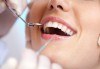 Погрижете се за здравето на зъбите си! Шиниране на разклатен, парадонтозен зъб и почистване на зъбен камък, от Дентална клиника Персенк! - thumb 1