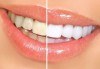 За красиви и бели зъби! Профилактичен преглед от специалист, почистване на зъбен камък и полиране с Air flow от VPDent, в центъра на София! - thumb 2