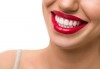 Професионално избелване на зъбите с LED лампа, почистване на зъбен камък, полиране, реминерализация и обстоен дентален преглед в Дентален кабинет Д-р Хаджийска! - thumb 1