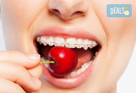 Здрави и красиви зъби! Консултация с ортодонт и 15 % отстъпка от цената на лечението с брекети в DentaLux! - Снимка 1