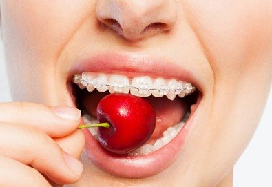 Здрави и красиви зъби! Консултация с ортодонт и 15 % отстъпка от цената на лечението с брекети в DentaLux!