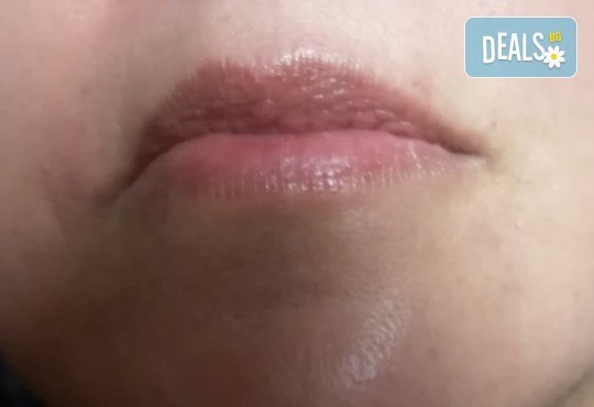 Оформяне на устни с впечатляващ ефект чрез микроиглена мезотерапия със серум на Fusion, специално разработен за видим ефект и обемни устни, в Център за естетична и холистична медицина Симона! - Снимка 4
