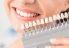 Професионално домашно избелване на зъби с индивидуални шини, профилактичен преглед, ултразвуково почистване на плака и зъбен камък в Deckoff Dental! - thumb 1
