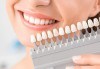 За очарователна усмивка! Избелване на зъби в домашни условия с индивидуални шини от Д-р Киров! - thumb 3